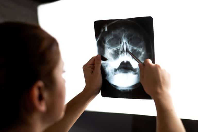 Person holding an xray of a human head up to a light board. They are holding the image in their left hand and pointing at the nasal cavity with a long silver instrument in their right hand.